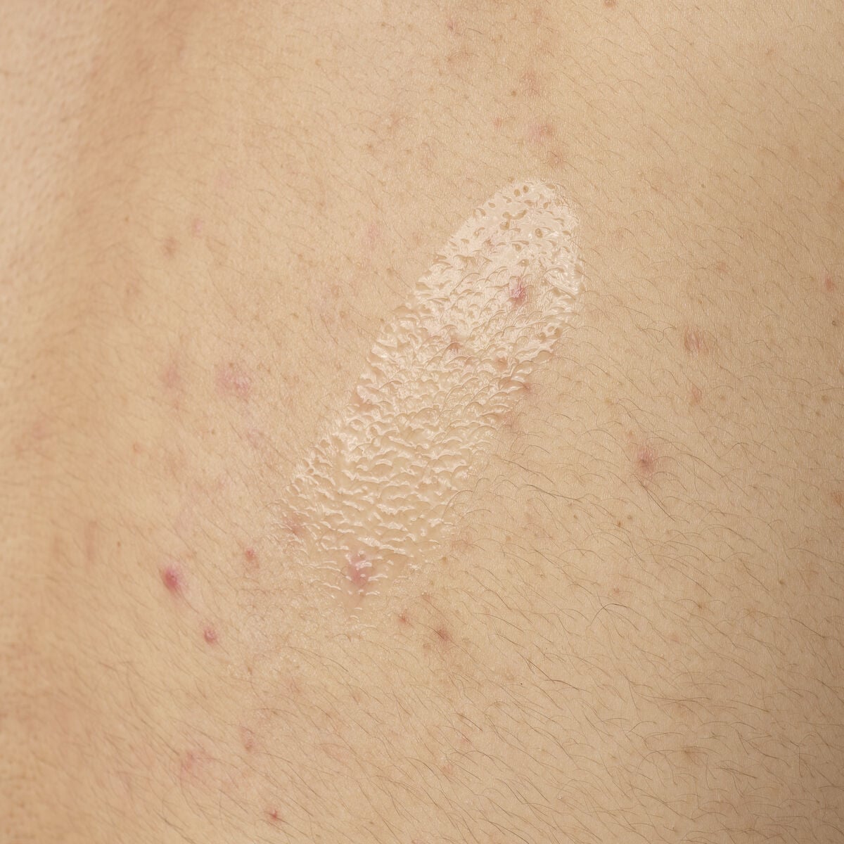 salicylic-acid-0-5-body-serum-q5 ORD-salicylic-acid-05-body-240ml-application.jpg
