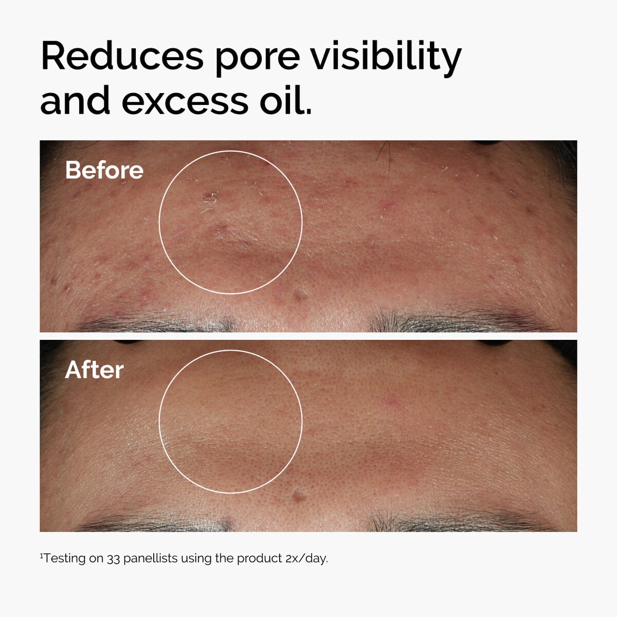 niacinamide-10-zinc-1-y8 ord-niacinamide-zinc-blemish-serum-before-after-pores.jpg