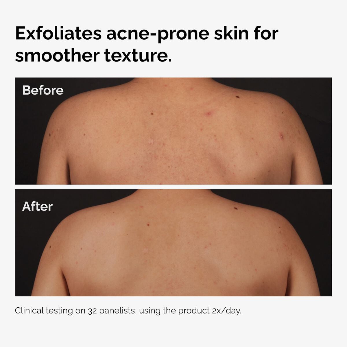 salicylic-acid-0-5-body-serum-p7 ord-salicylic-acid-body-serum-before-after-graphic-NA.jpg