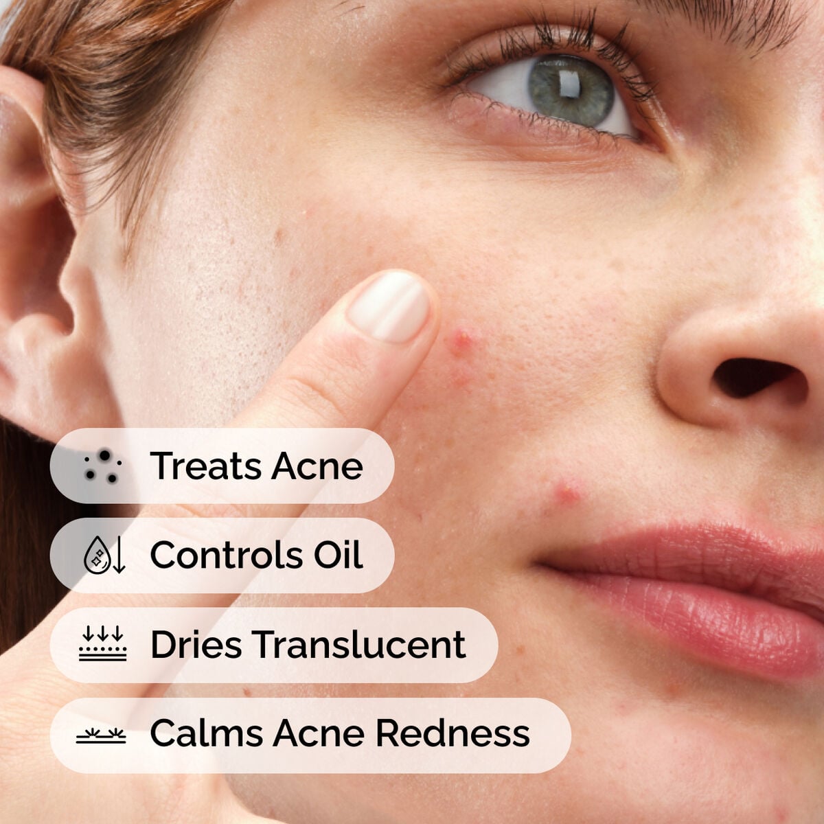 sulfur-10-powder-to-cream-concentrate-m4 ord-sulfur-10pct-powder-to-cream-concentrate-model-application-with-benefits-acne.jpg