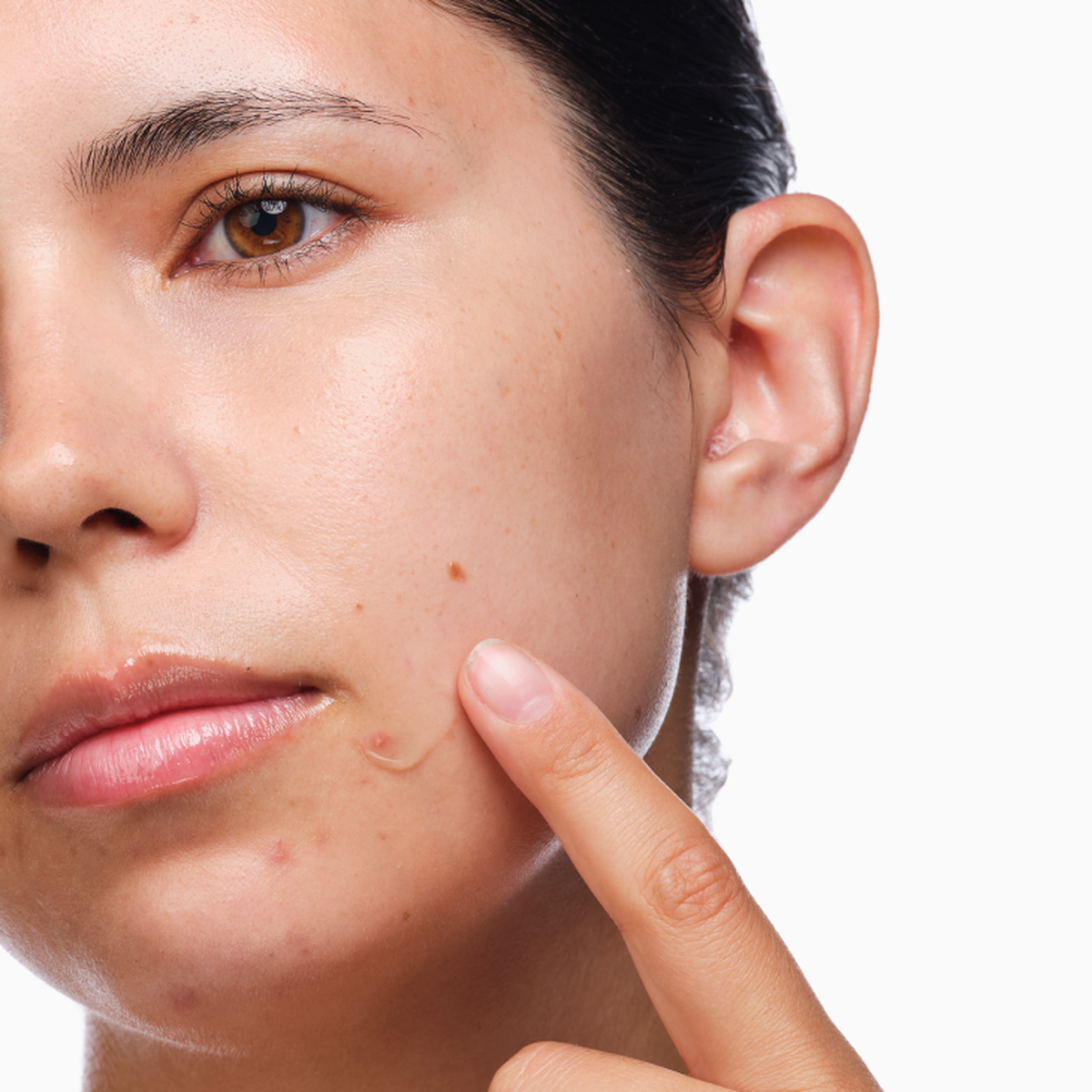 the-acne-set-a3 rdn-the-acne-set-application.png